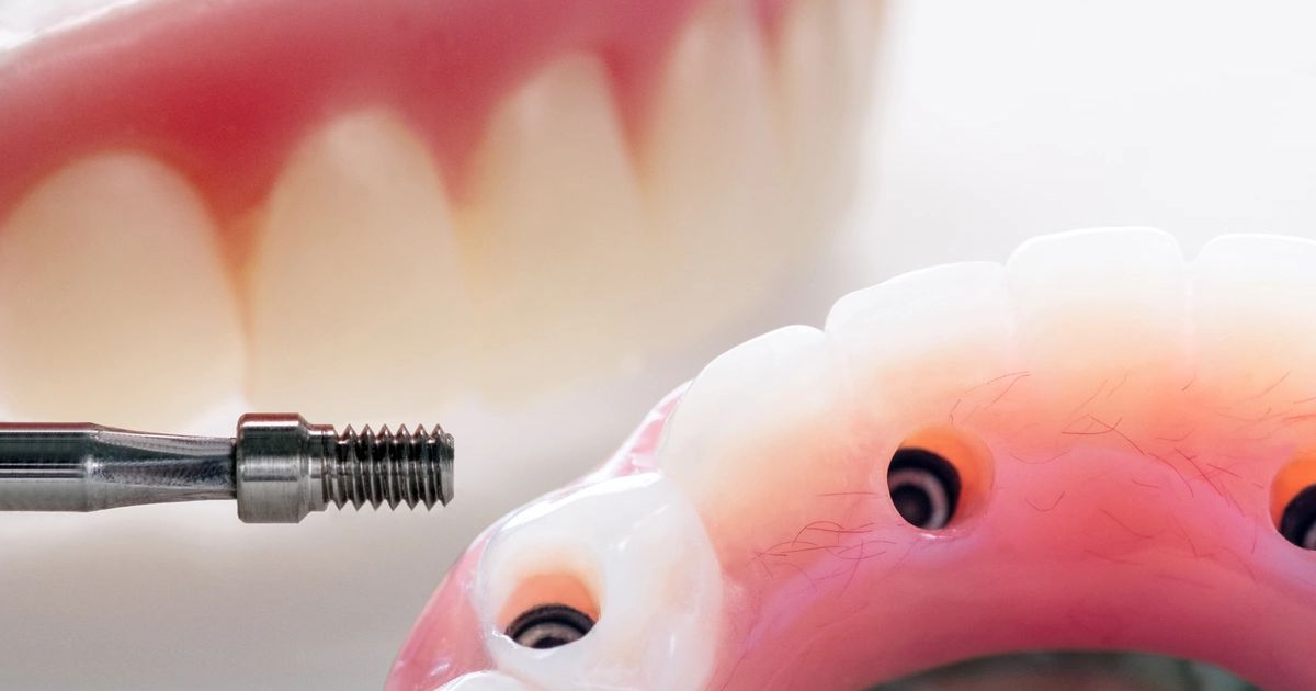 All-on-4 vs All-on-6: Which Full-Arch Implant Is Right for You?