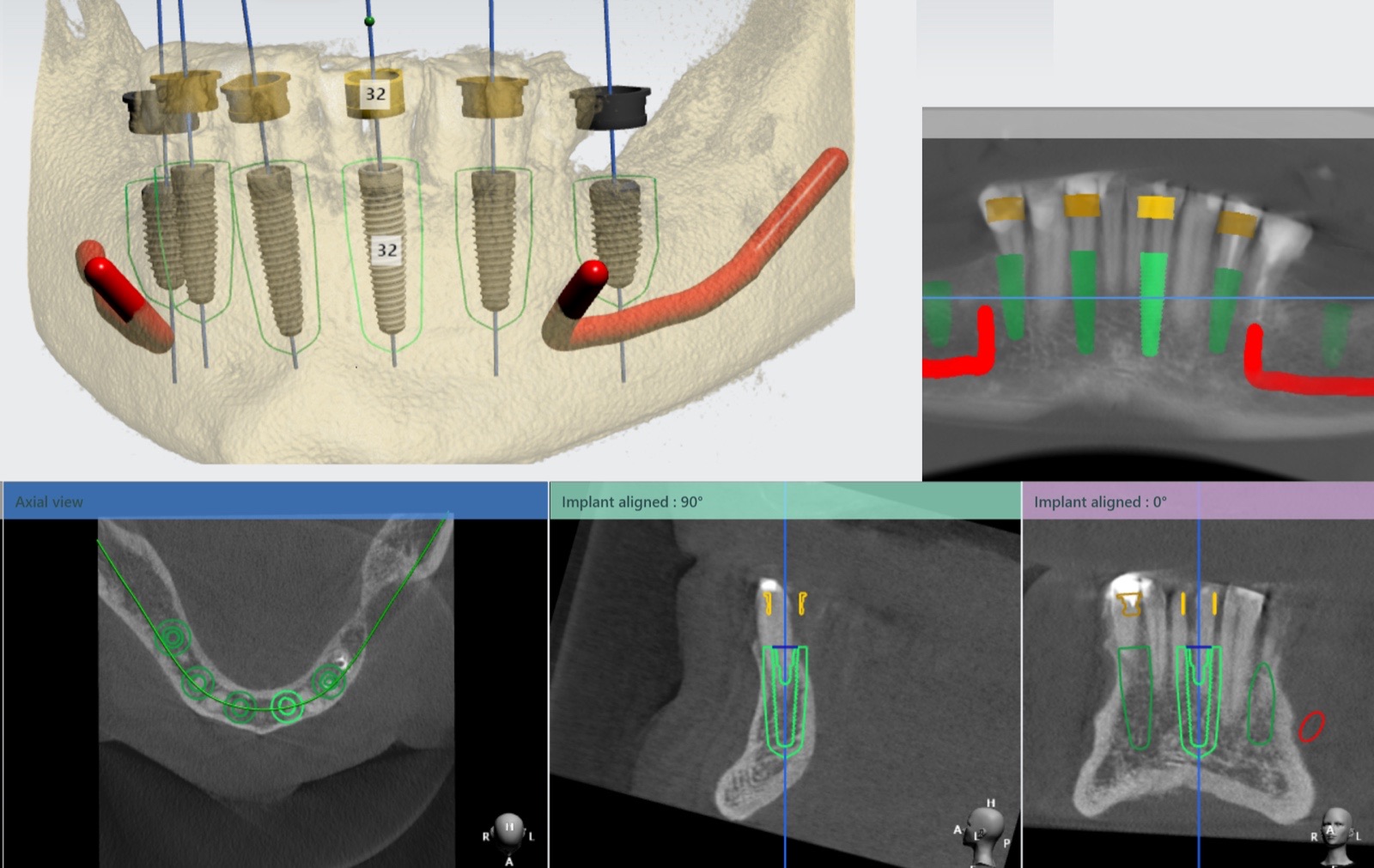 Three-dimensional CBCT implant planning: implants positioned in the lower jaw with the nerve canal mapped, shown in 3D, panoramic, axial and cross-sectional views