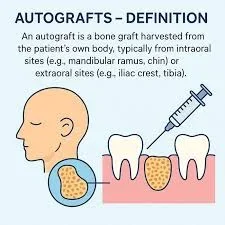 Autograft