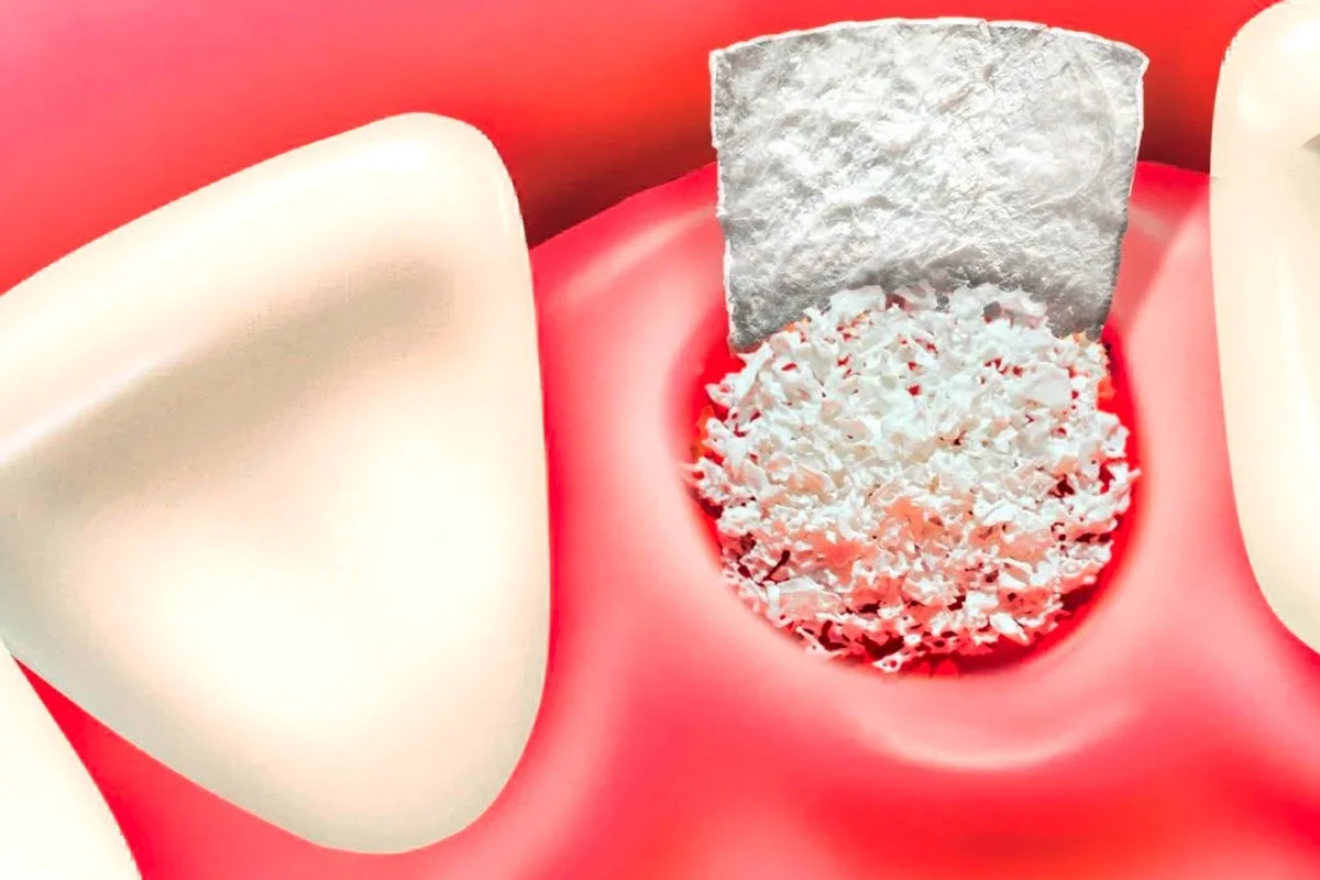 Allograft
