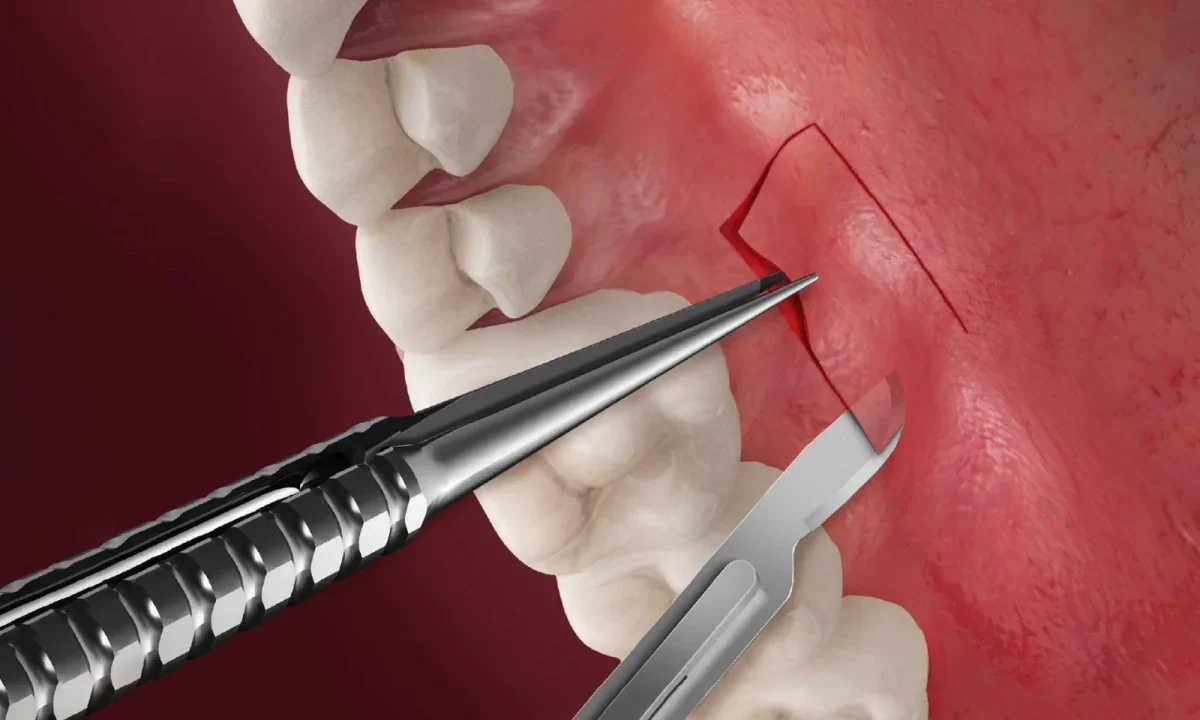 Soft Tissue Grafting
