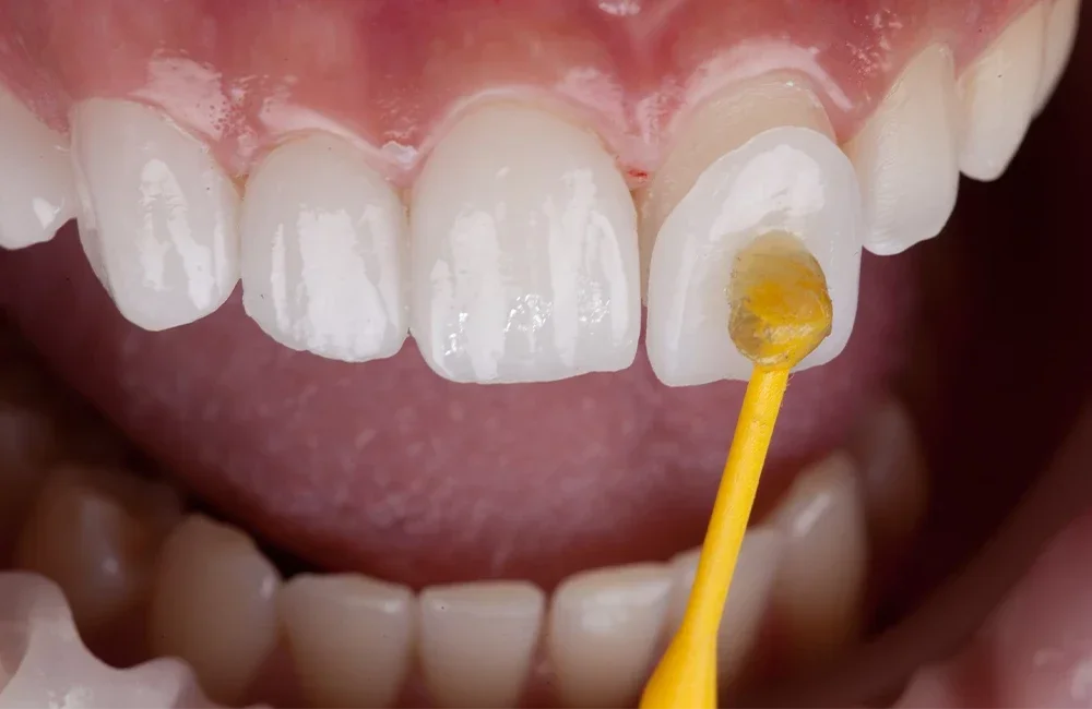 Dental Veneers