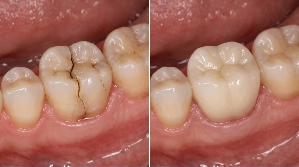 After same-day crown