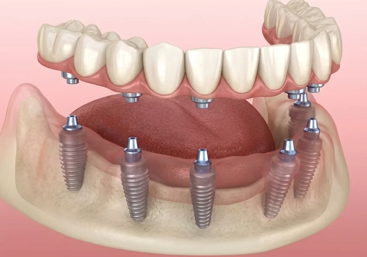 All-on-6 Implants