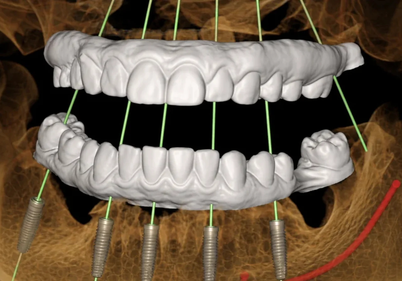 Guided surgery technology
