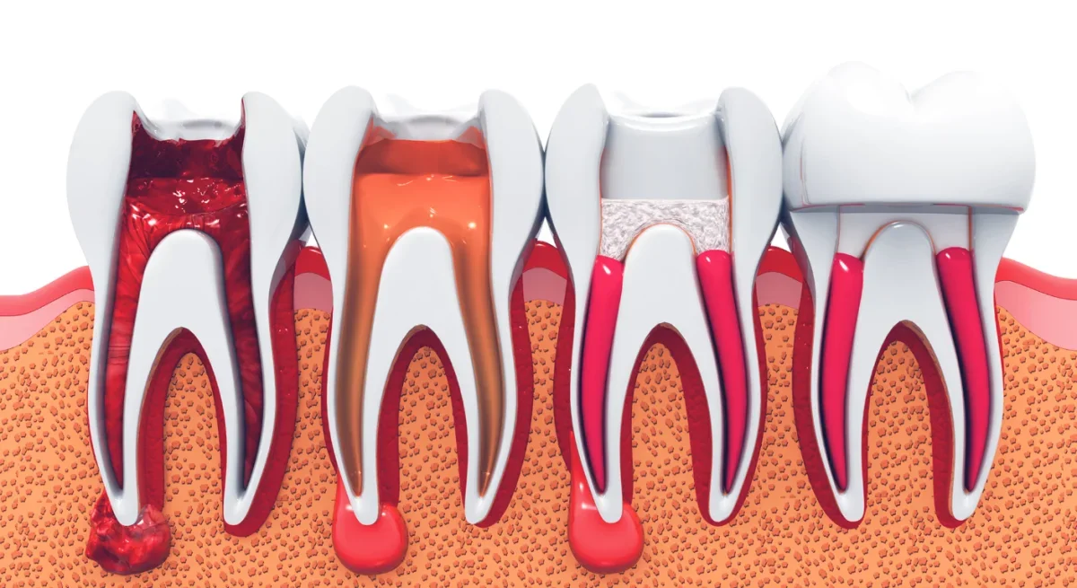 Root Canal Therapy