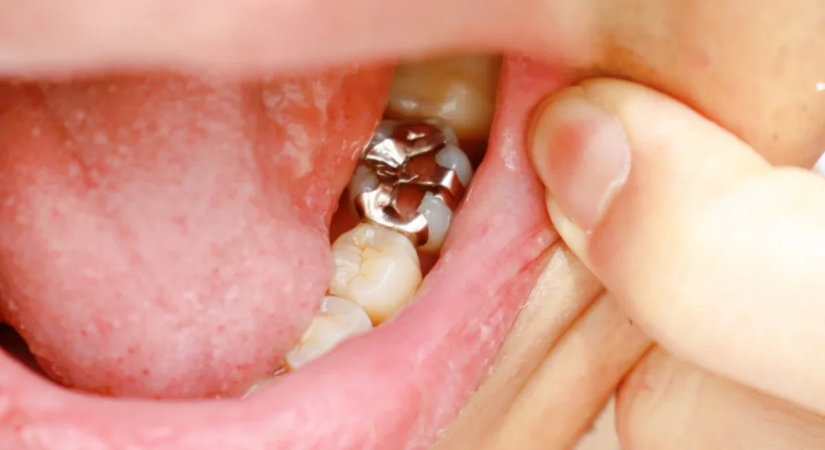 Cavity Fillings