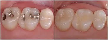 Cavity Fillings