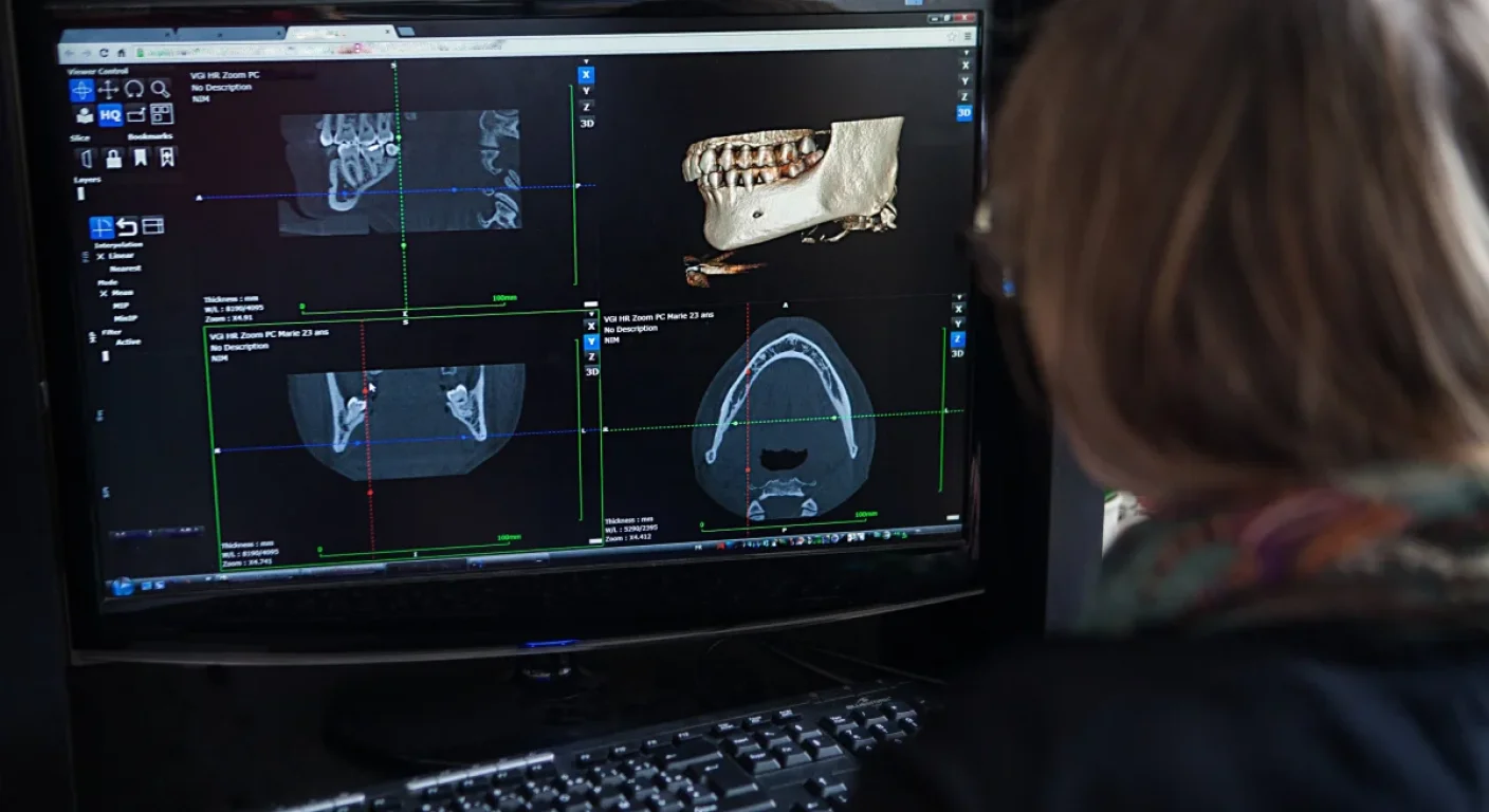 3D computer-guided implant surgery planning