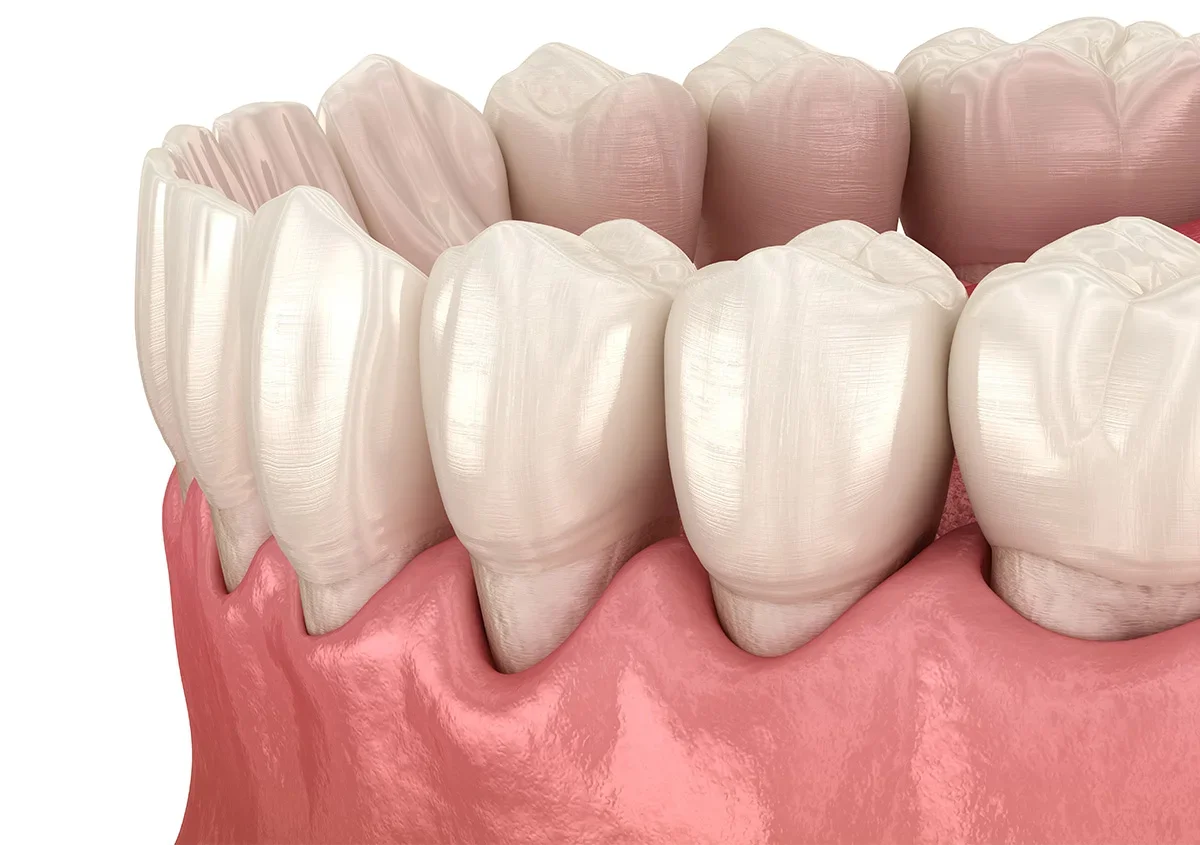 Periodontal treatment procedure
