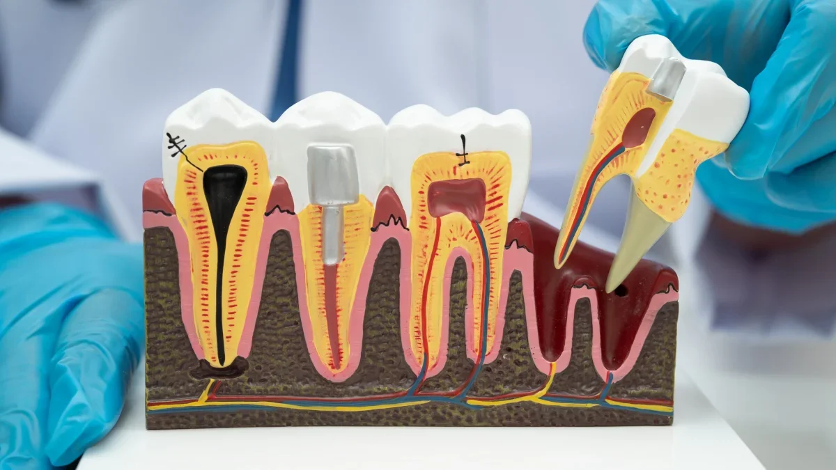 Root Canal Therapy