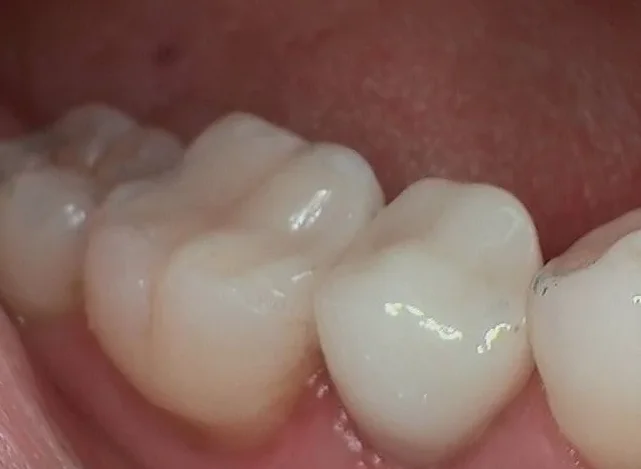CEREC Same-Day Crowns
