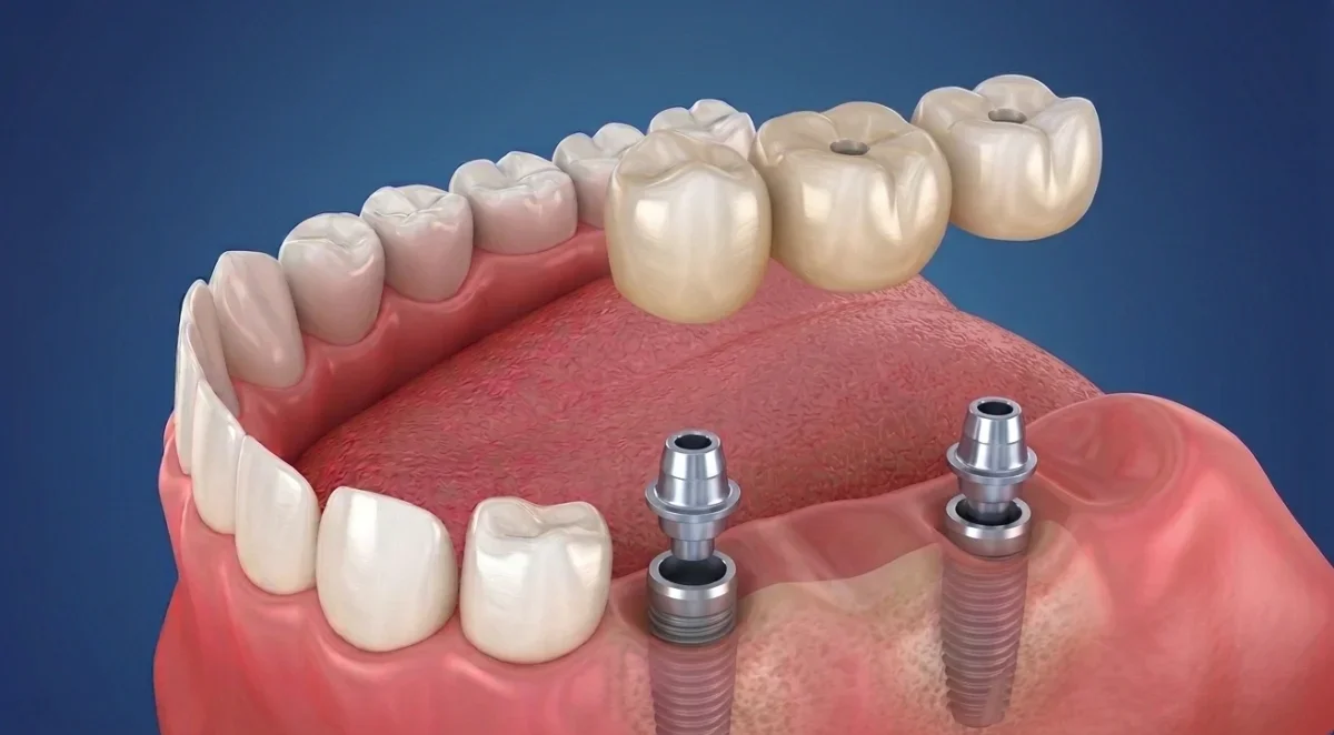 Dental Bridges