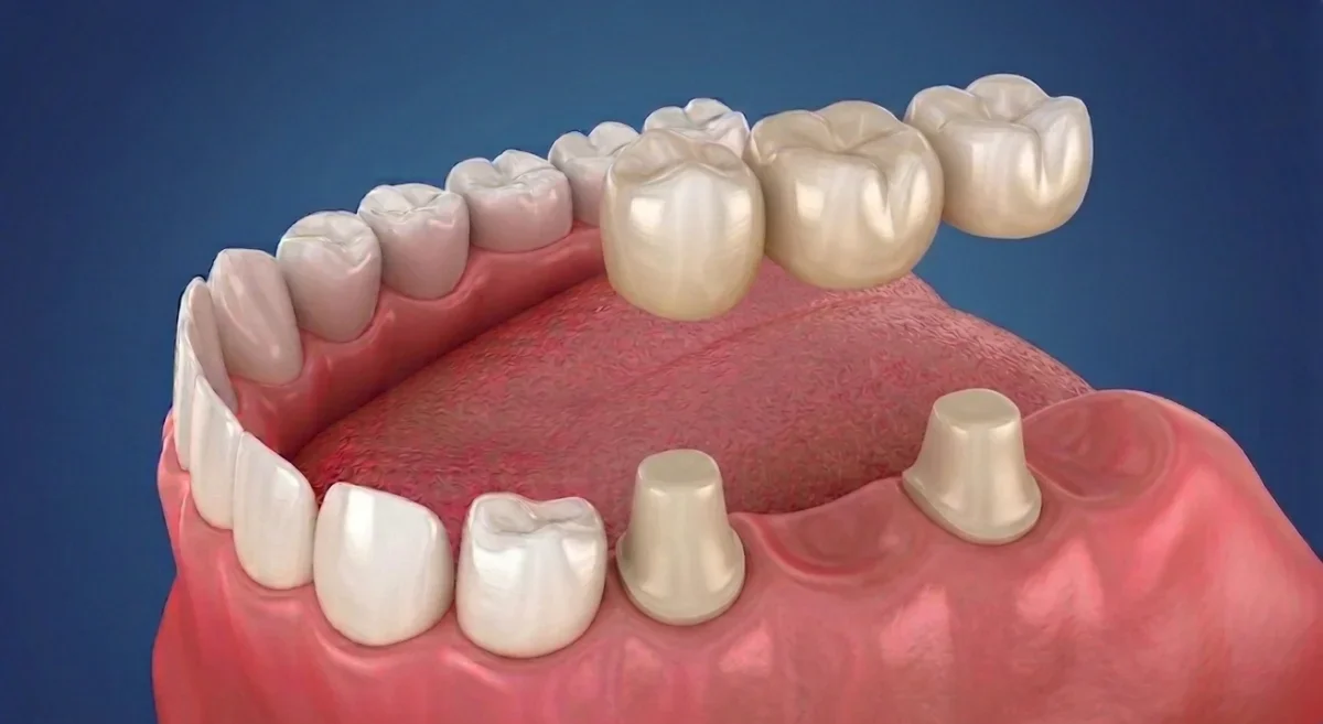 Dental Bridges