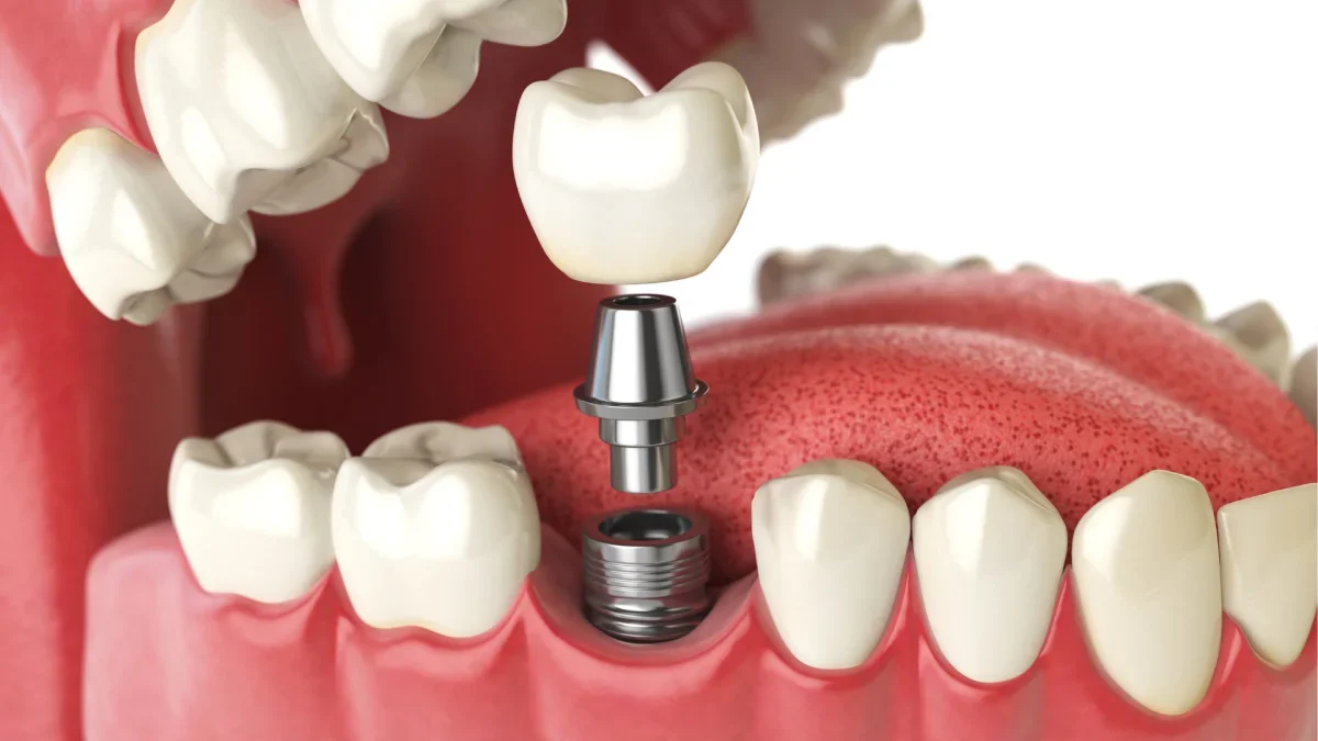 Dental Implants