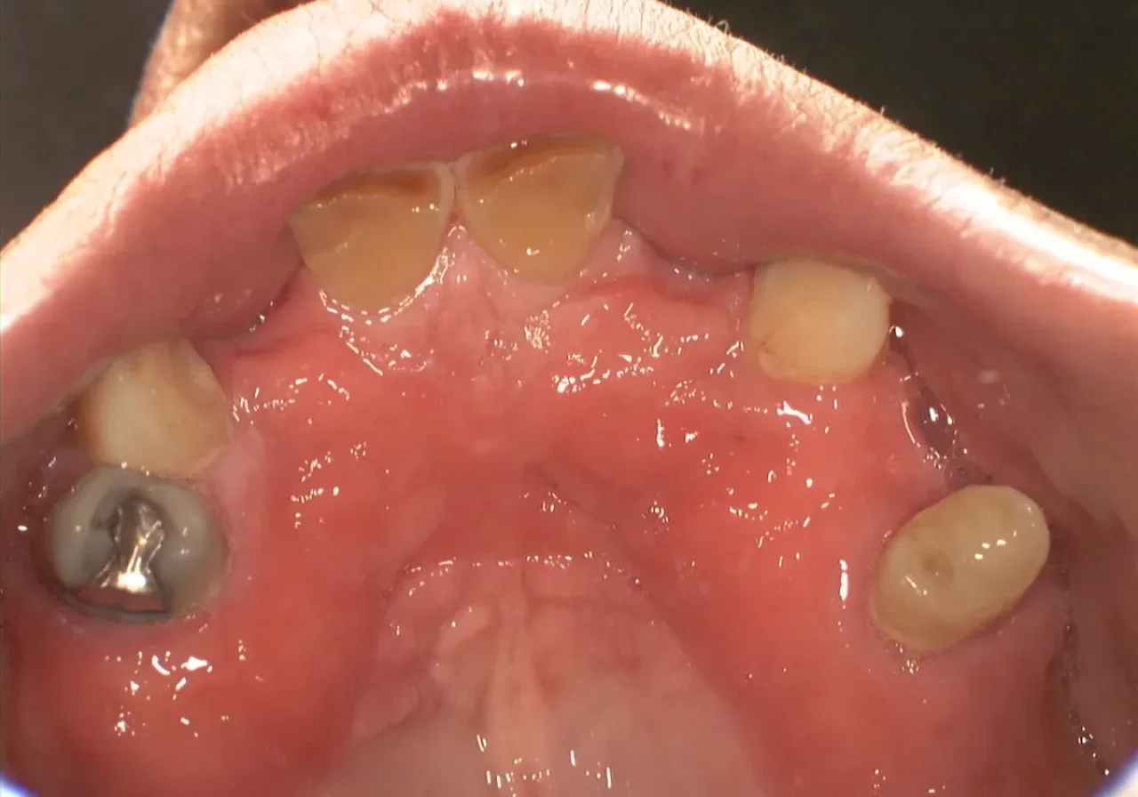 Before multiple tooth bridge