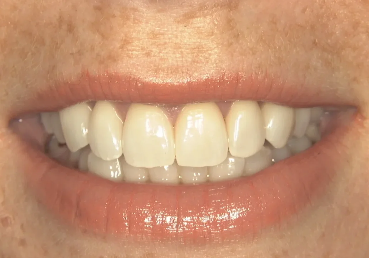 After full-arch implant treatment — complete smile restoration