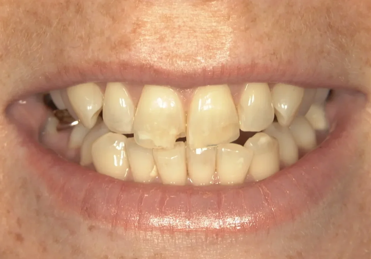 Before full-arch implant treatment — failing dentition