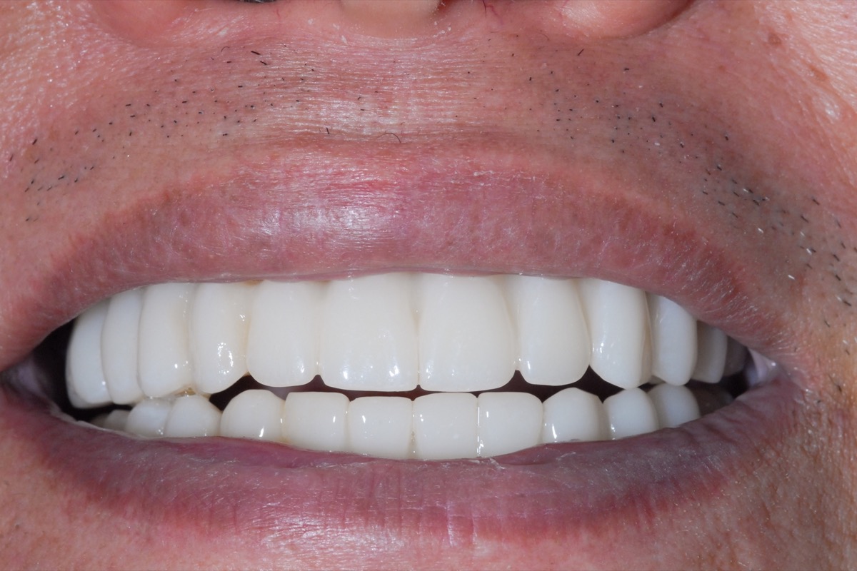 After — fixed bridges on six implants in each arch, the full upper and lower restored