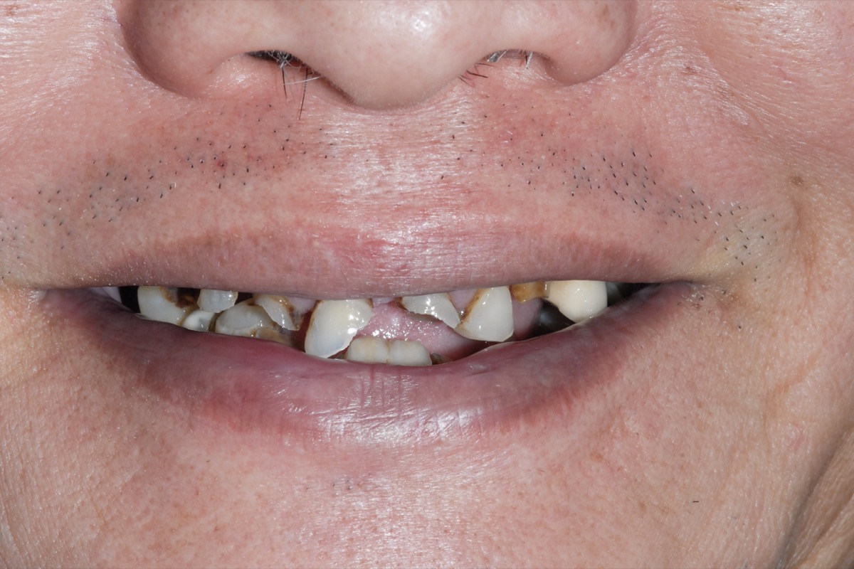 Before — teeth broken down to the gum line, dark with decay, with several already lost
