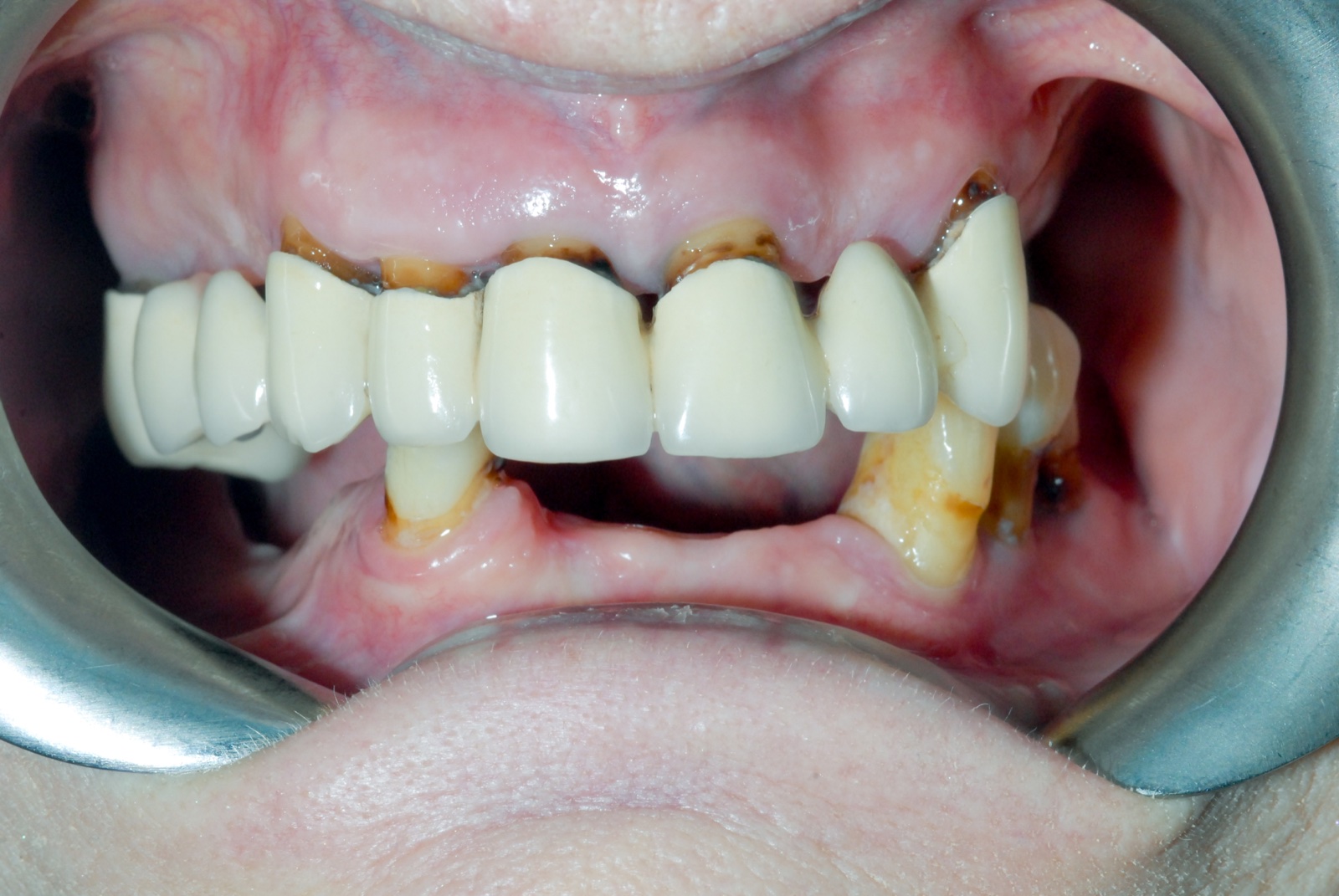 Before — all-on-6 restoration, upper arch