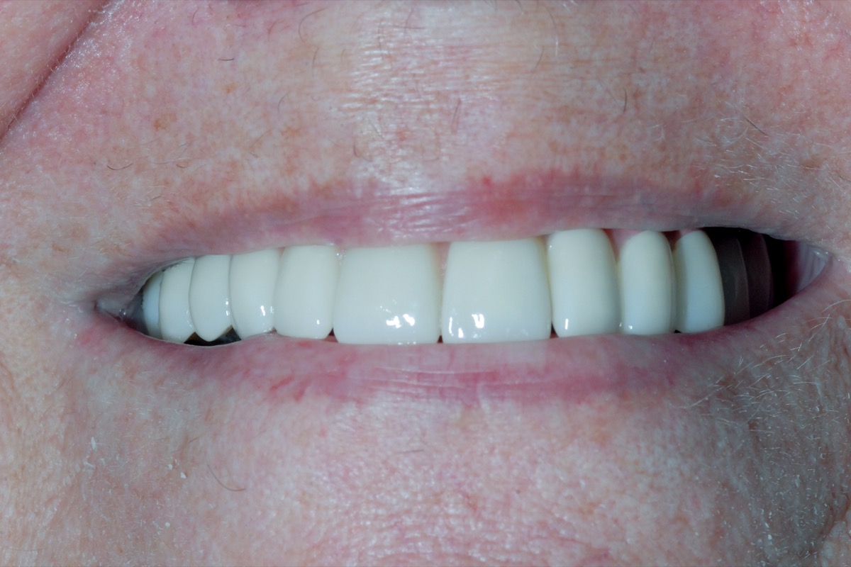 After — fixed bridges on six implants in each arch, straight and even across the arch