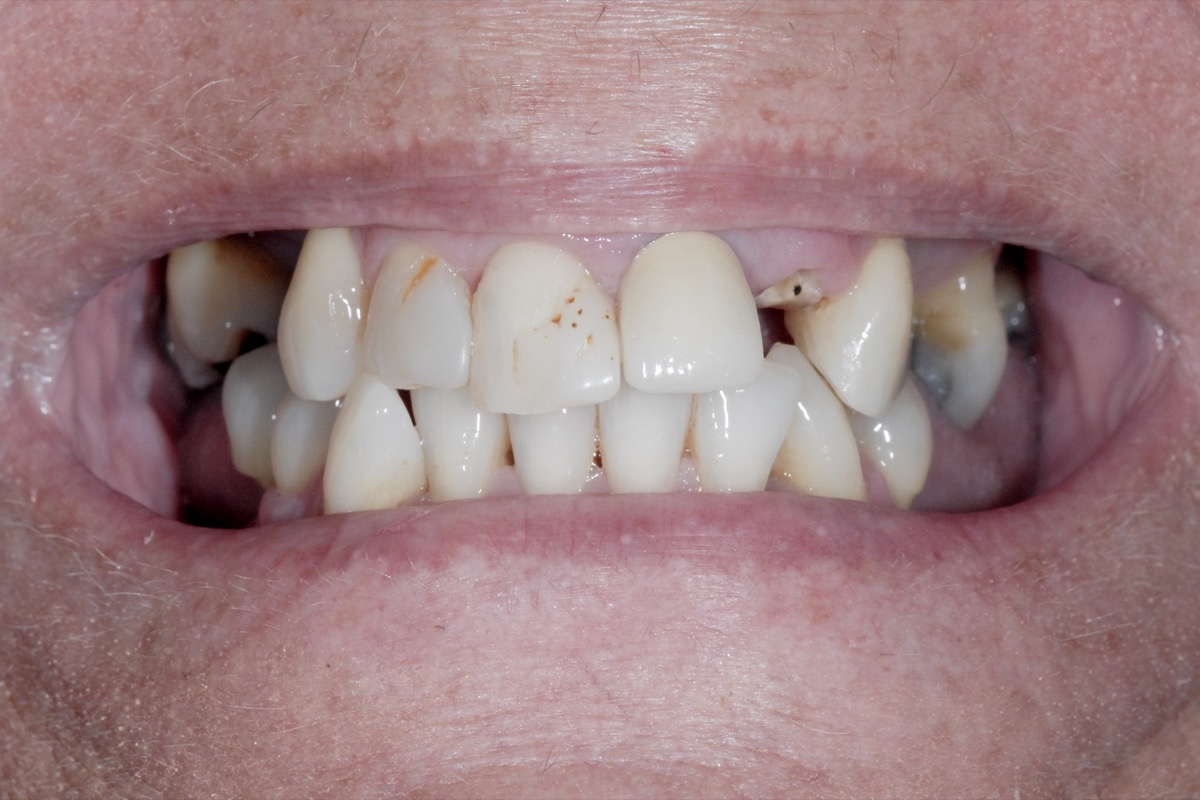 Before — crowded upper teeth, chipped and discoloured, with gaps where teeth had broken