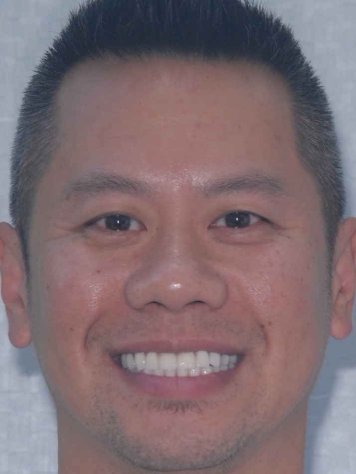 After — the bite rebuilt on implants, the lower face restored in height
