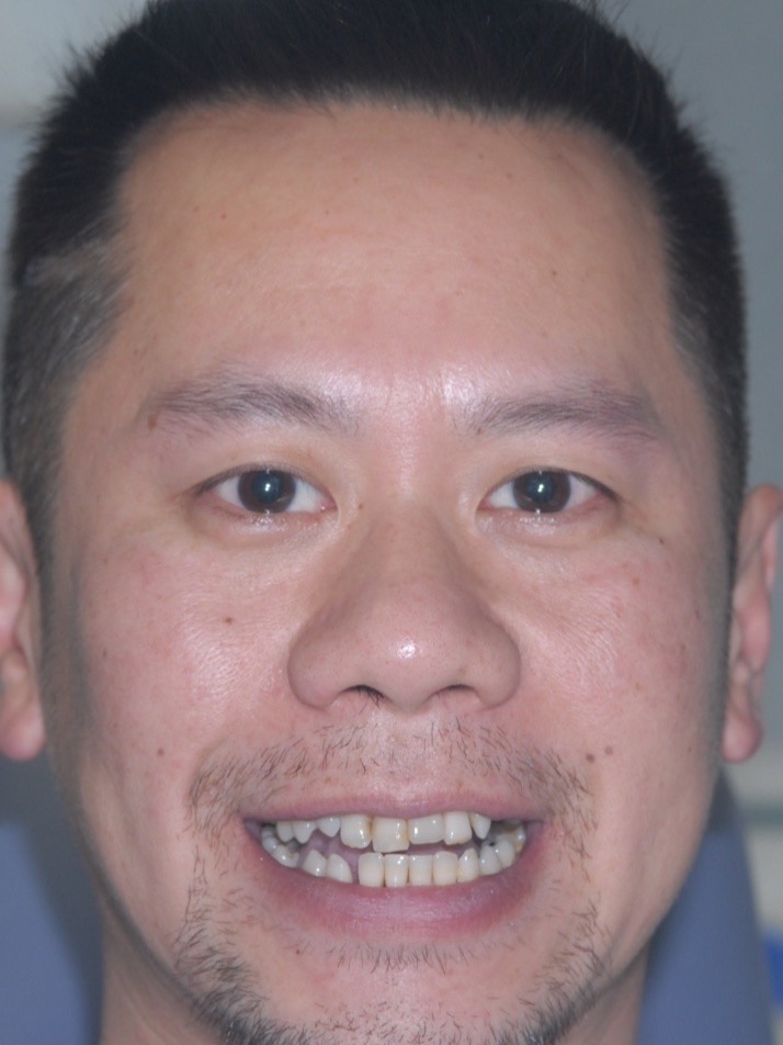 Before — the lower face shortened, the mouth drawn in over a failing bite