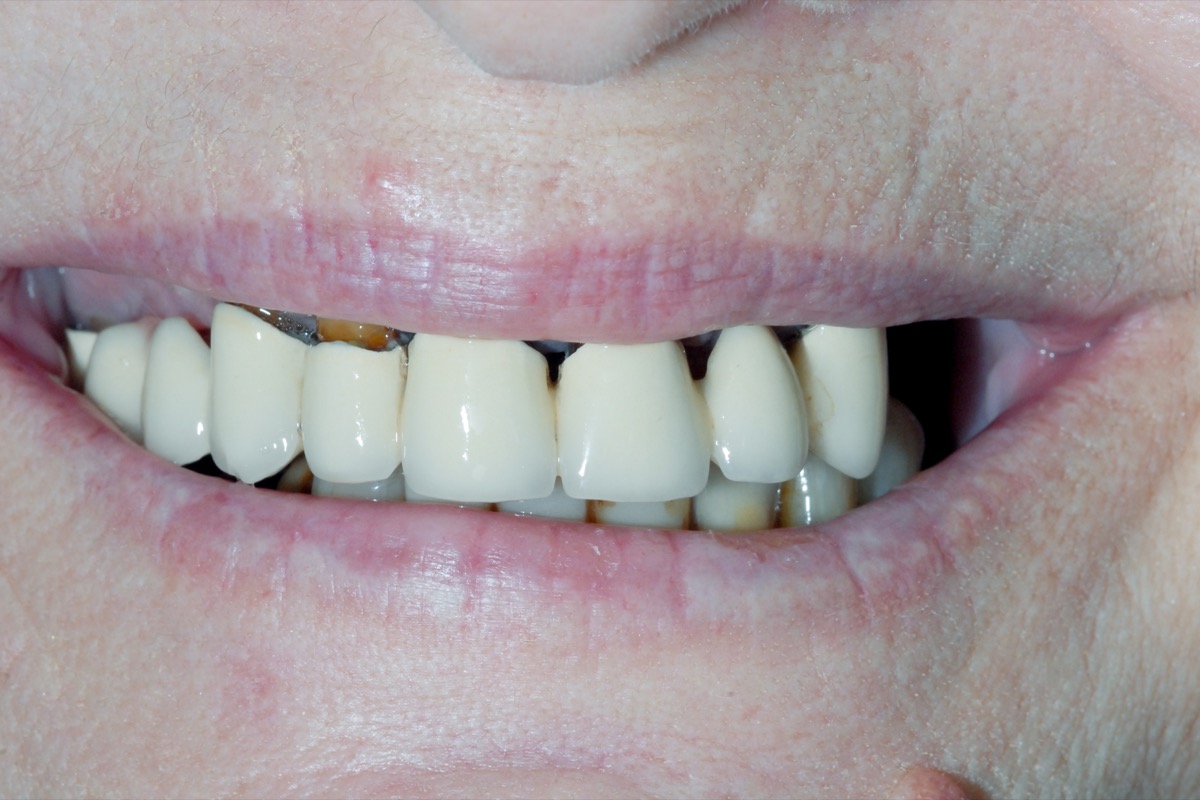 Before — older restorations darkened at the margins, the teeth beneath them discoloured