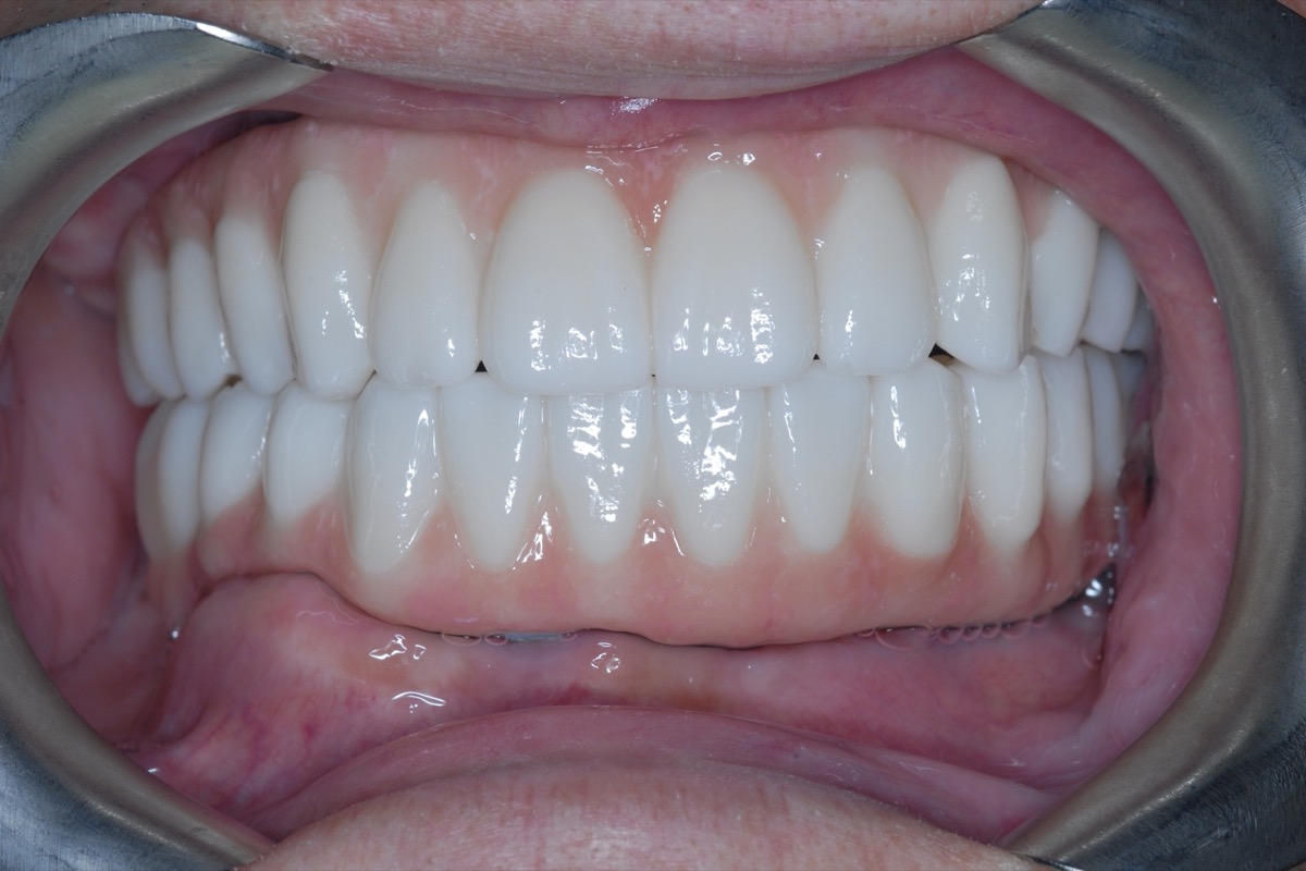 After — full-arch bridges on six implants in each arch, even in shade, length and alignment