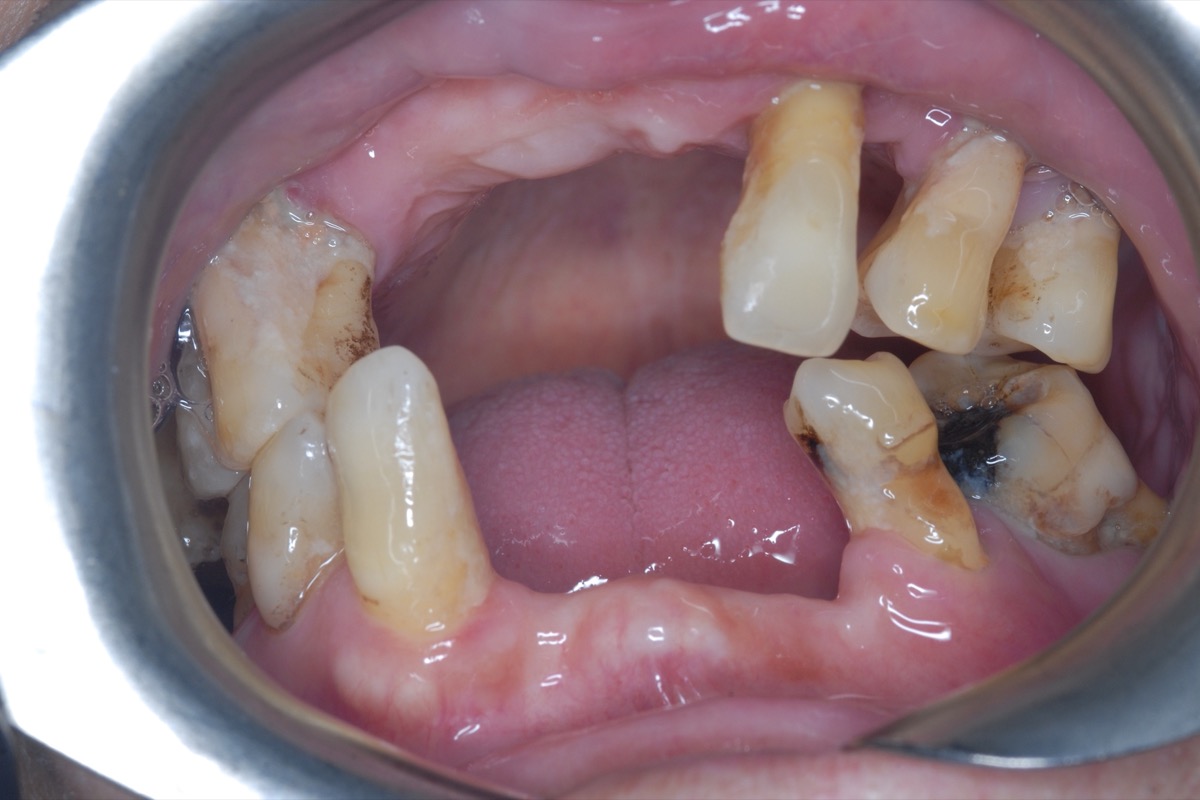 Before — only a few teeth left, broken down to the gum and dark with decay