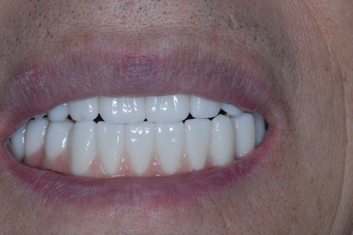 After — full-arch bridges on six implants in each arch, even in shade, length and alignment