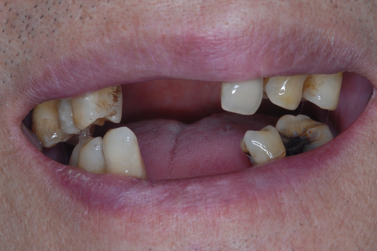 Before — heavy decay with several teeth already lost, the remainder broken at the edges