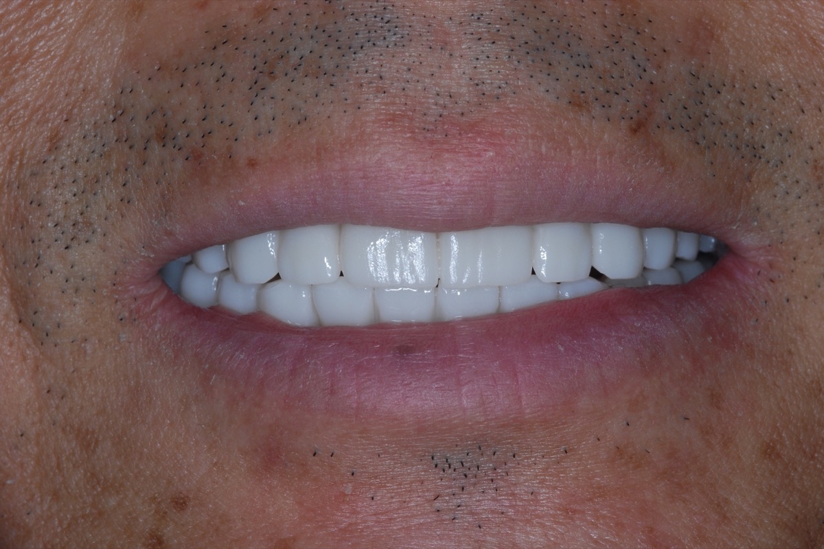 After — the same smile with full-arch bridges in place, even in shade and length
