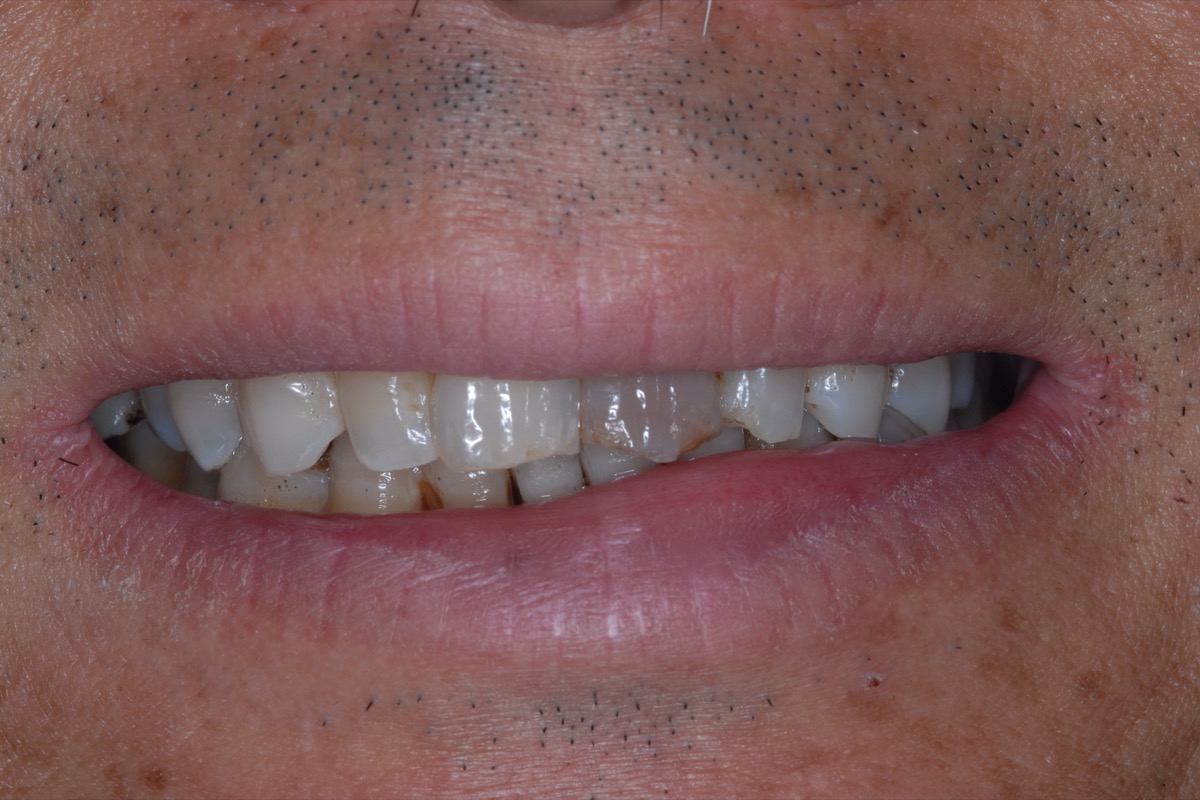 Before — the smile showing dark, uneven teeth with gaps along the edges