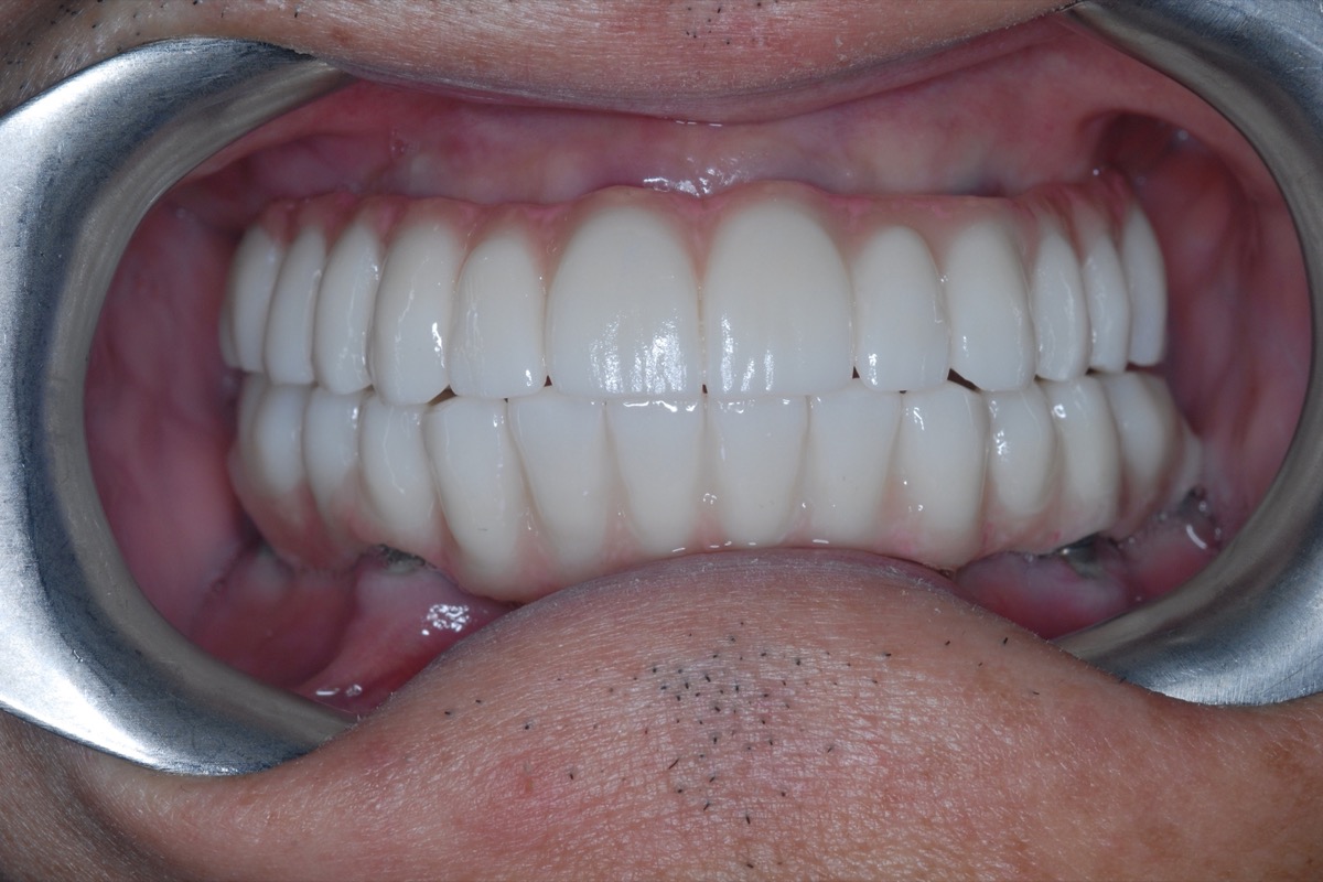 After — with the lips held back, full-arch bridges carried on six implants in each arch