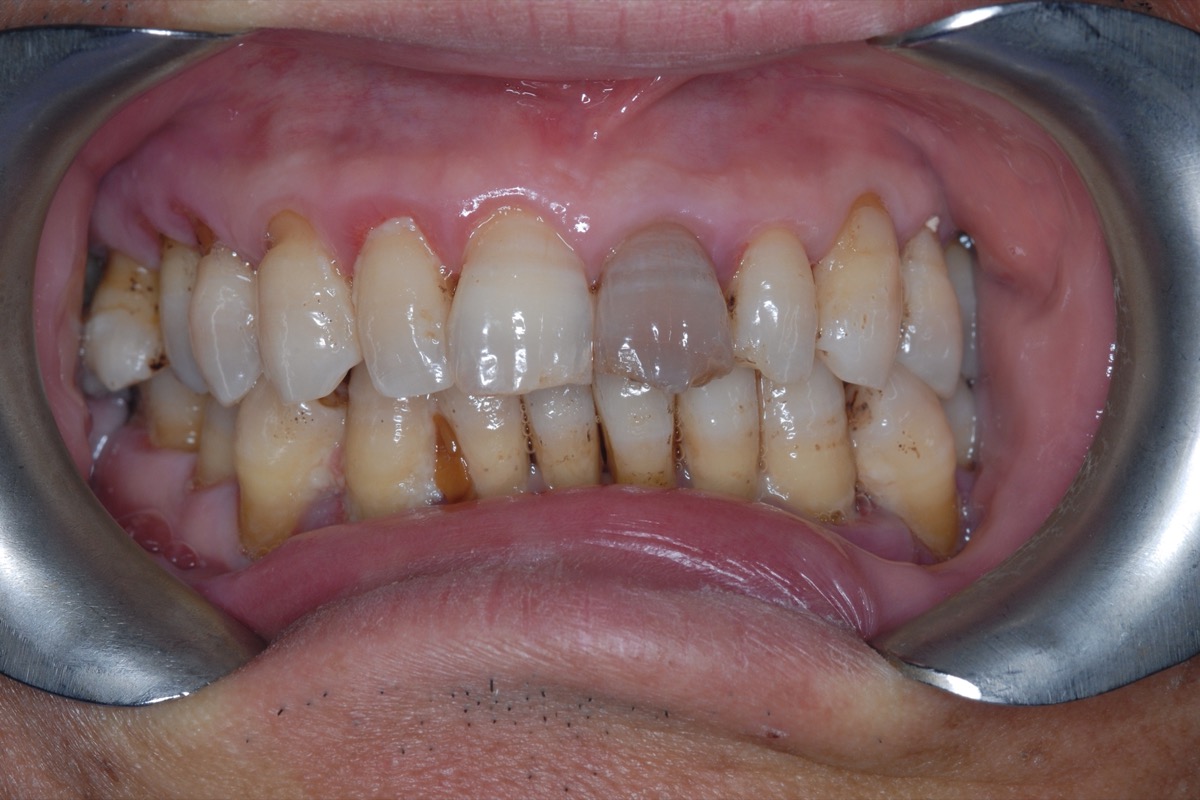 Before — with the lips held back, the teeth yellowed and uneven, one darkened, the gums receded