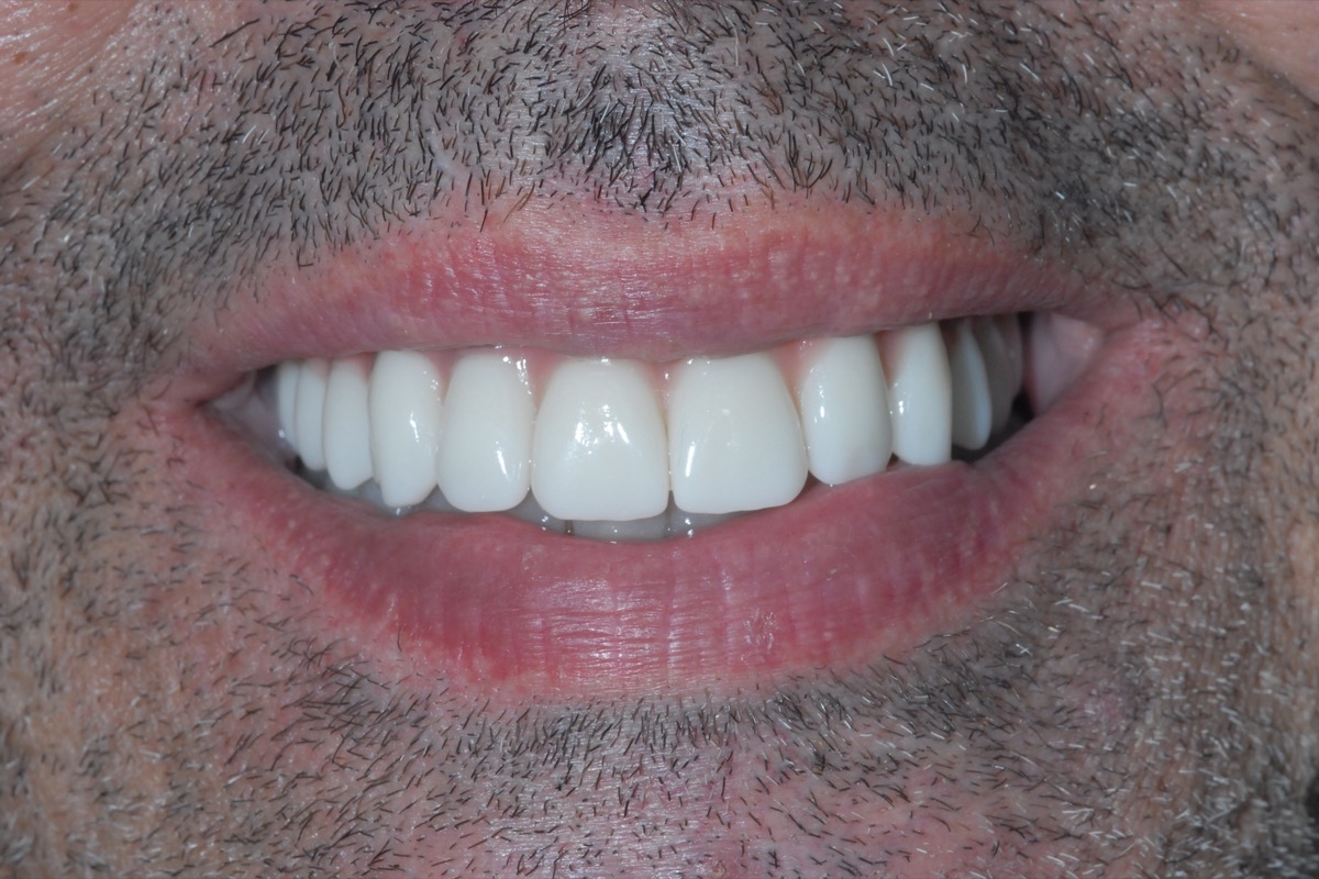 After — fixed bridges on six implants in each arch, uniform in shade and contour