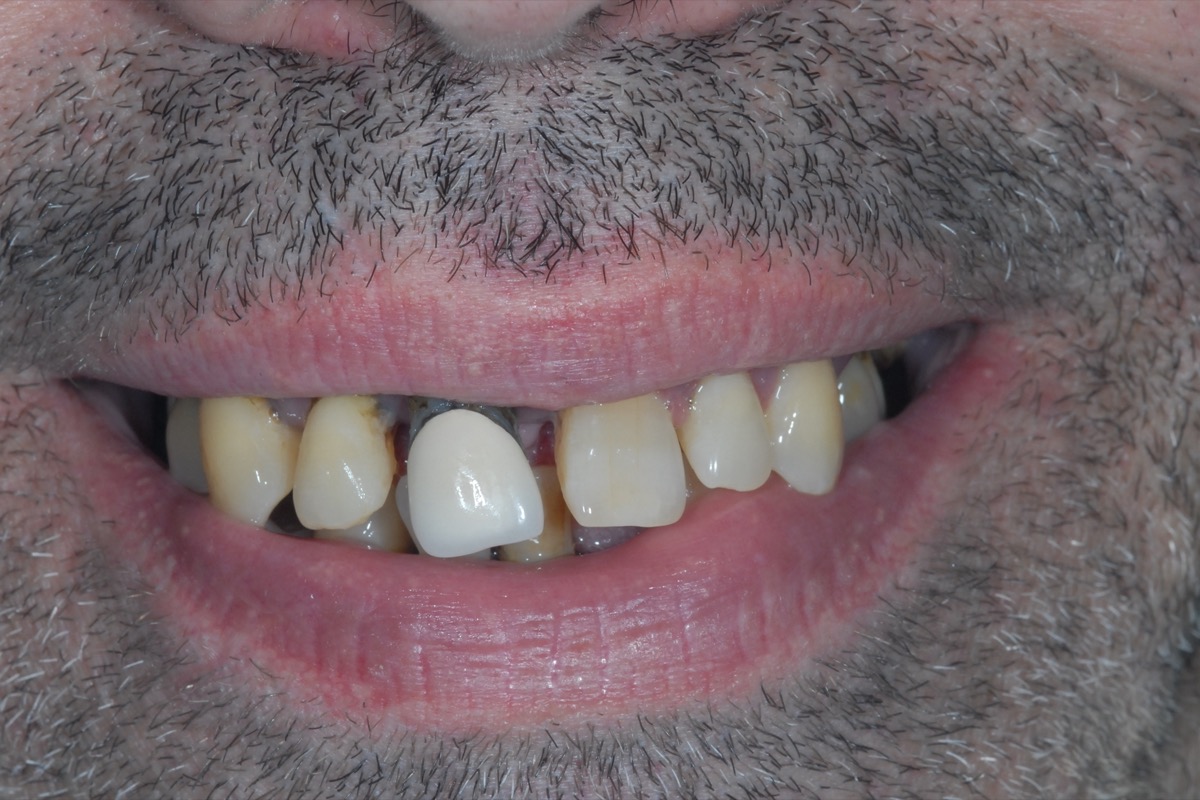 Before — a fractured tooth among others failing at the gum line