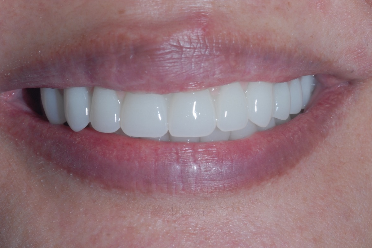 After — fixed bridges on six implants in each arch, even in shade and alignment