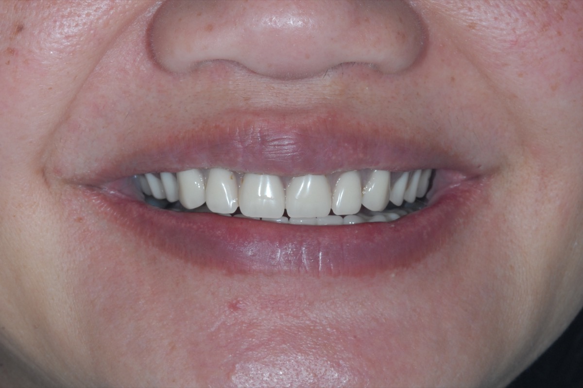 Before — the smile as it was with removable dentures in place