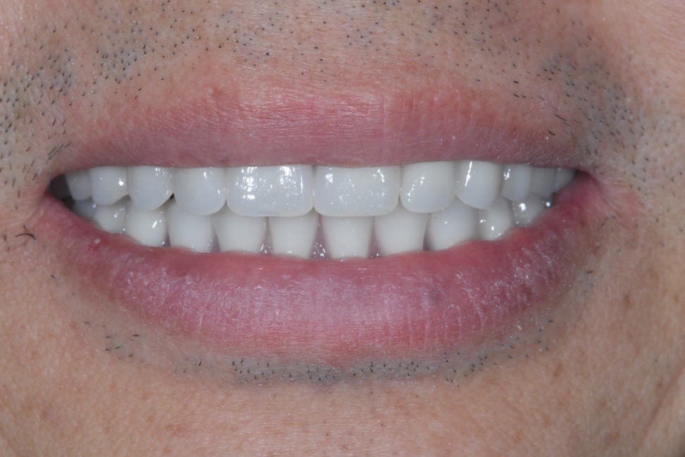After — full-arch bridges on six implants in each arch, even in shade, length and alignment