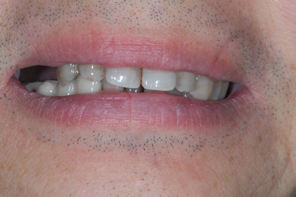 Before — dark margins along the gum line, with teeth missing towards the back
