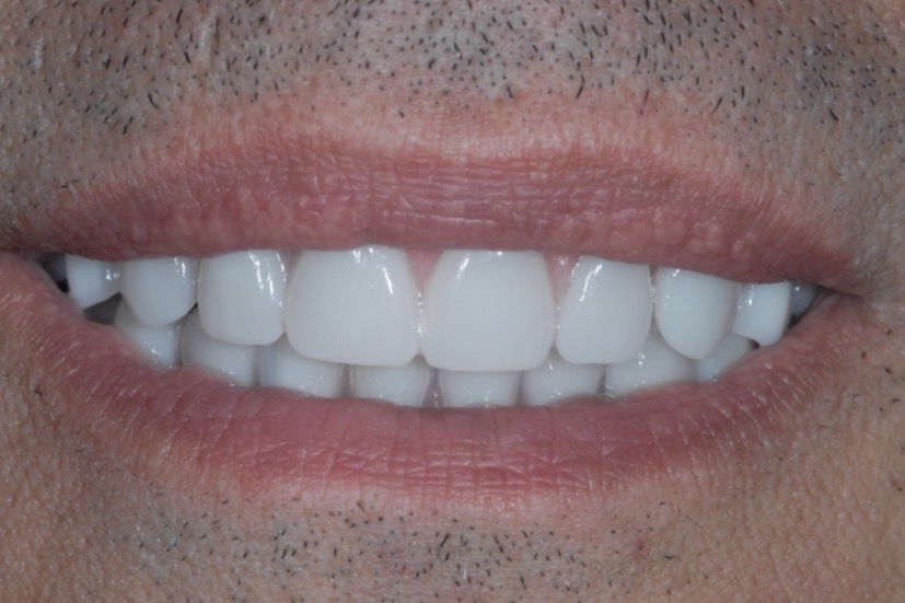 After — full-arch bridges on six implants in each arch, even in shade, length and alignment