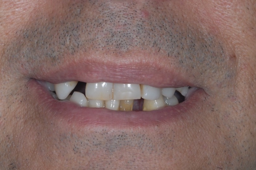 Before — gaps between the front teeth, the edges uneven and chipped