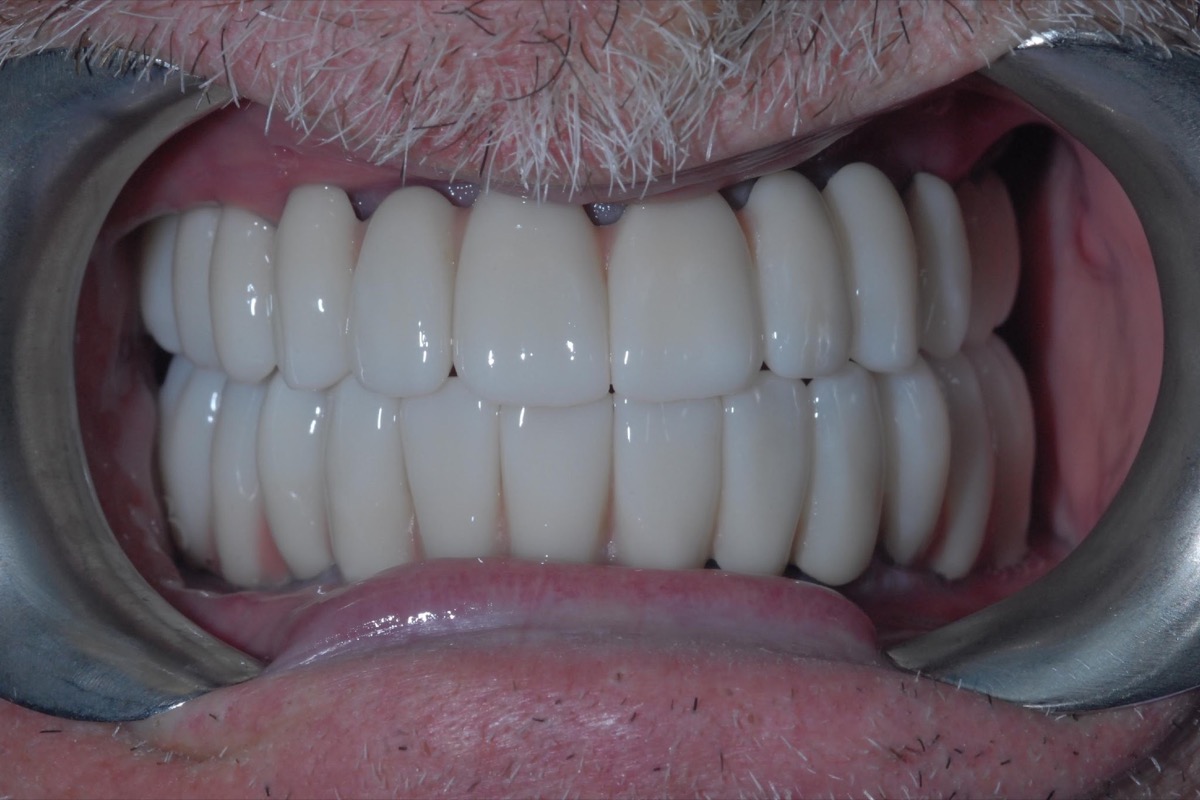 After — with the lips held back, full-arch bridges carried on six implants in each arch