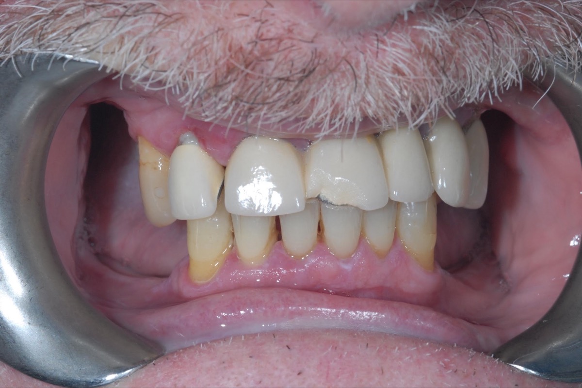 Before — with the lips held back, the teeth heavily worn and the gums receded, exposing the roots