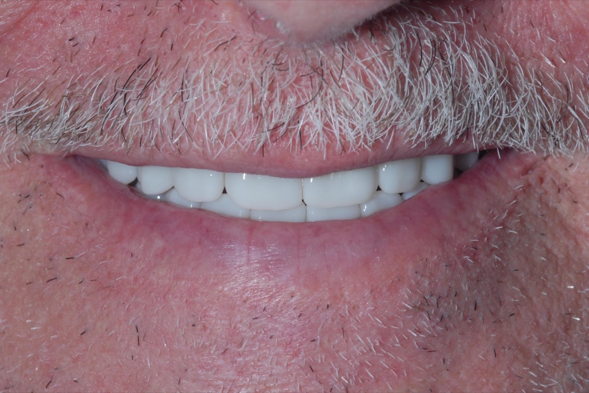 After — the same smile with full-arch bridges in place, restored to full length