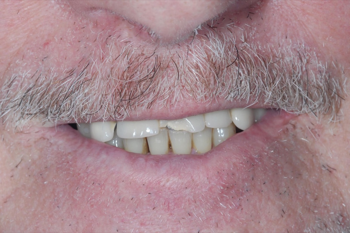 Before — the smile showing teeth worn short and flat, little of them visible below the lip